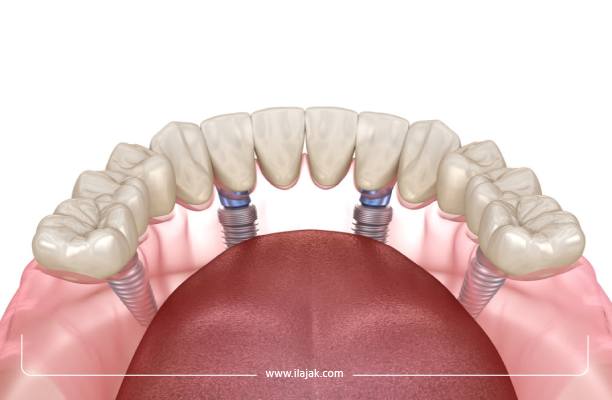 All-on-4 dental implants in Turkey reviews