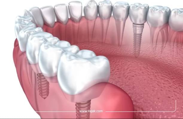 Les types d’implants dentaires en fonction de leur emplacement