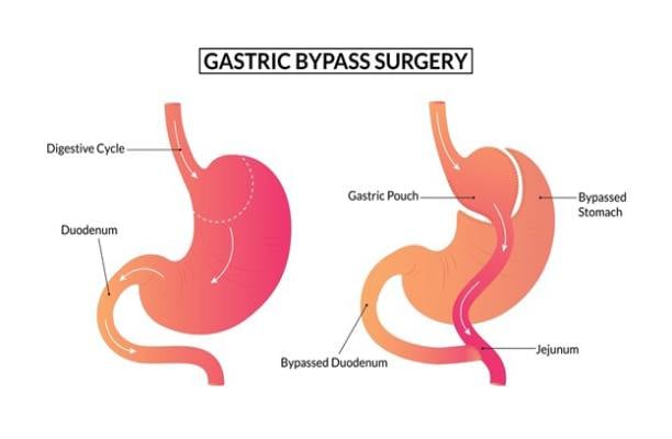 What is a gastric bypass?