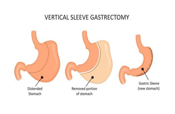 What is a gastric sleeve?
