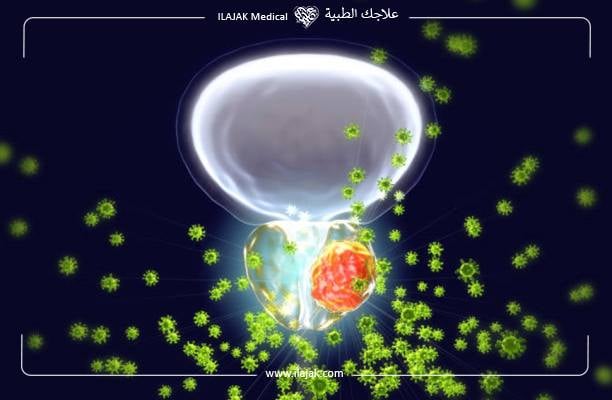 طرق علاج سرطان البروستاتا في تركيا