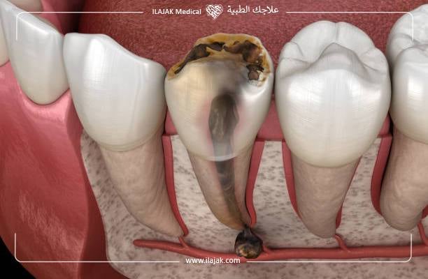 الفرق بين خراج اللثة وخراج الأسنان من حيث طرق العلاج