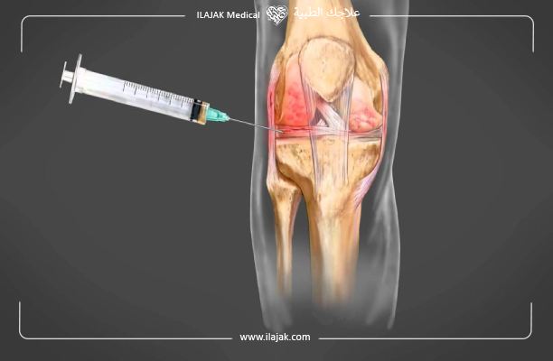 Injections PRP pour articulation