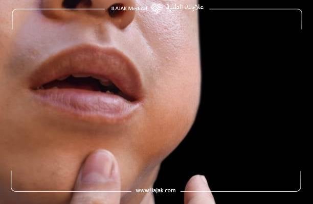 انتفاخ الغدد اللعابية في أرضية الفم في بعض الحالات. 