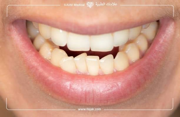 طرق علاج بروز الأسنان بعد التقويم