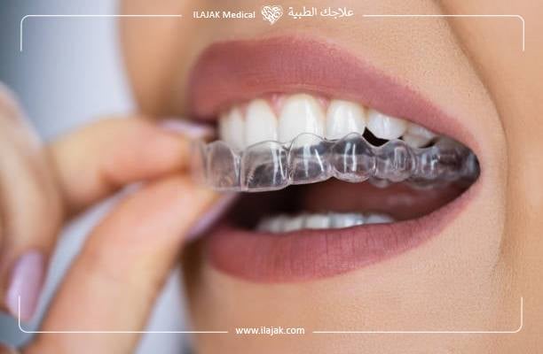 أهمية مثبت الأسنان بعد التقويم
