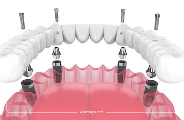 Définition des implants dentaires