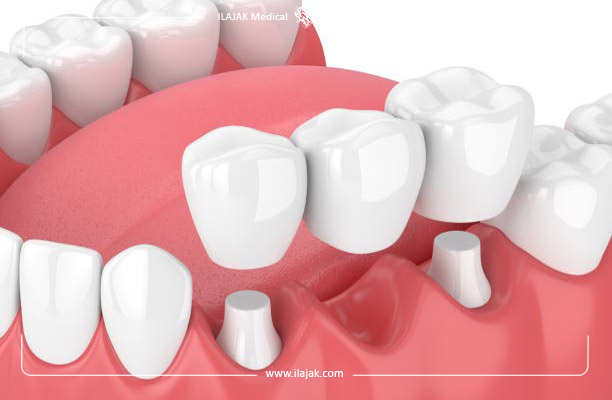 ما هي الأسنان الإصطناعية؟