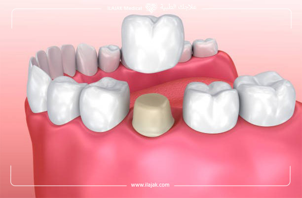 تركيبات الأسنان الإصطناعية الثابتة