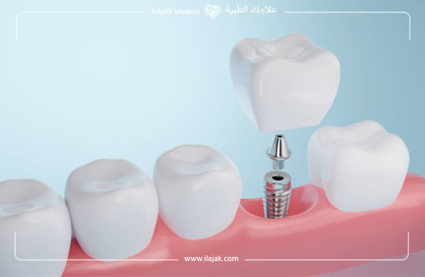تركيبات الأسنان الإصطناعية المتحركة