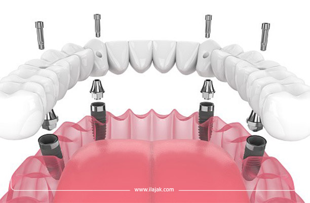 Définition des implants dentaires all-on-4