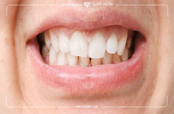 Définition de la malocclusion dentaire