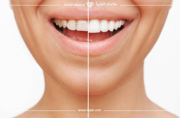 أنواع غطاء الأسنان التجميلي