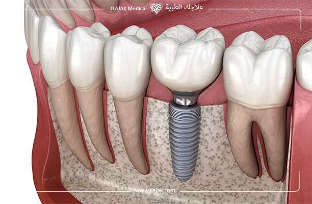 Dental Implants