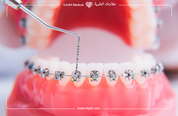 مرحلة تنفيذ إجراء تقويم الأسنان ضمن عيادات علاجك