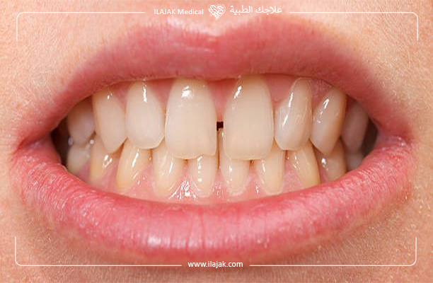 ما هو المقصود بفراغات الأسنان؟