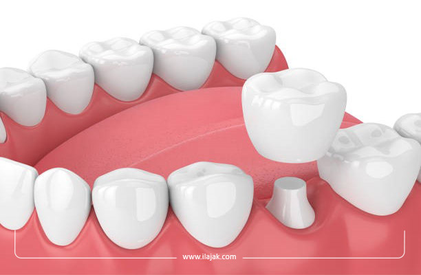 علاج الأسنان باستخدام تيجان 