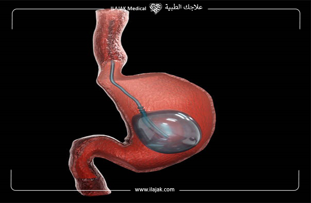 الكبسولة الذكية لعلاج السمنة