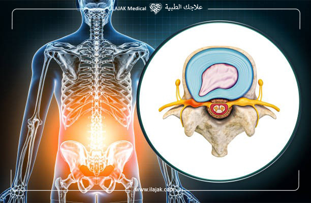 أسباب الانزلاق الغضروفي