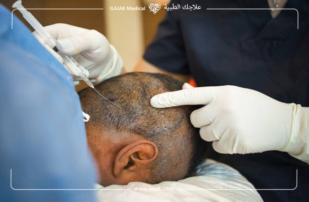 بزراعة الشعر من شعر الجسم