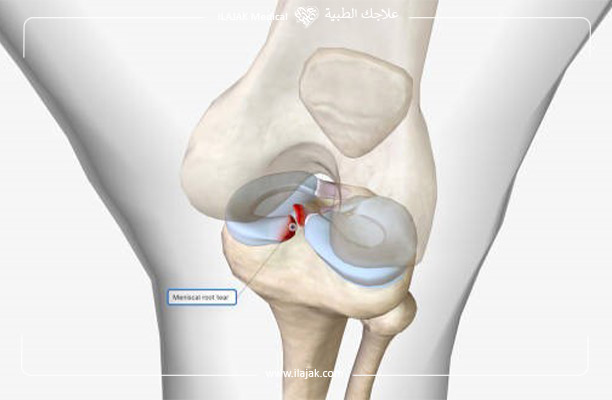 علاج تمزق الغضروف الهلالي