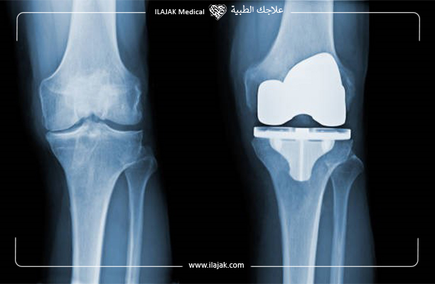 عملية استبدال مفصل الركبة