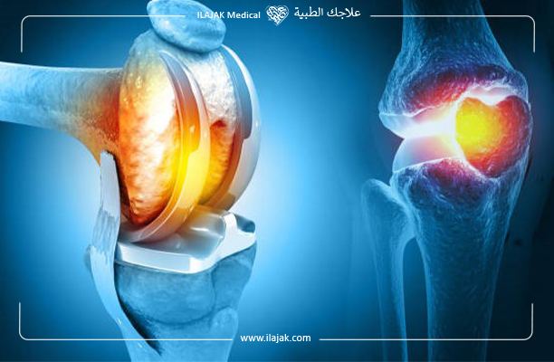 استبدال مفصل الركبة في تركيا