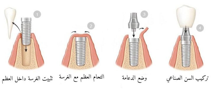 خطوات زراعة الأسنان الفورية