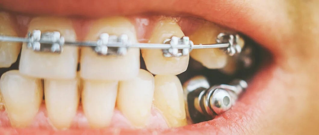 تقويم الاسنان و تأثيره على اللثة