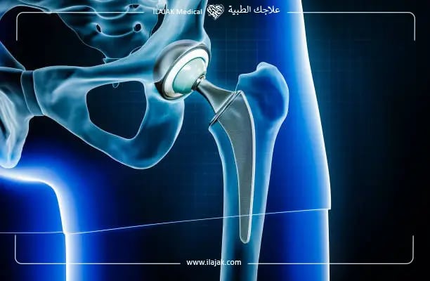 عملية استبدال مفصل الورك