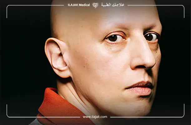 ثعلبة شاملة كل شعر الرأس