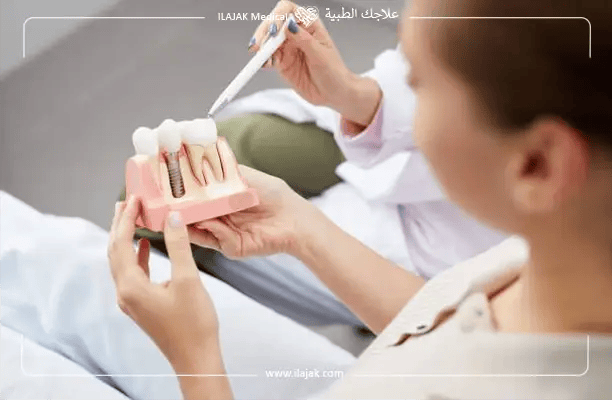 أنواع مسمار زراعة الأسنان