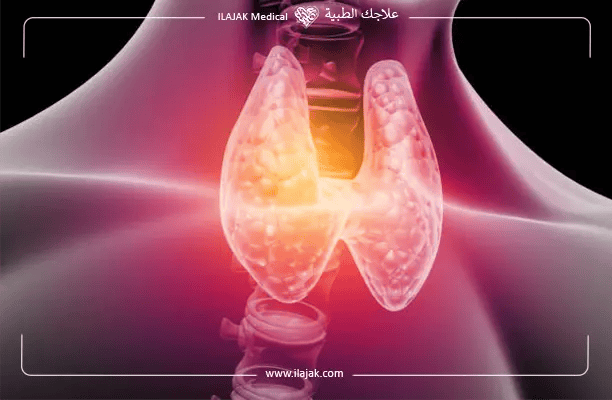 فرط نشاط الغدة الدرقية