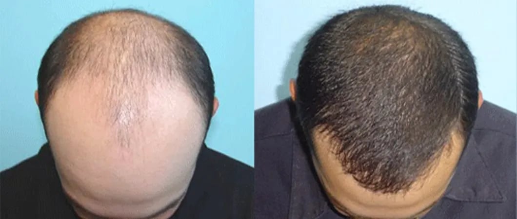 Hair Transplant in Turkey