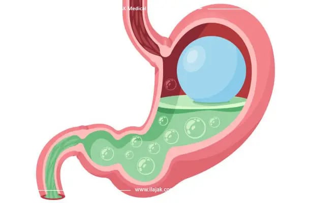 أضرار بالون المعدة 