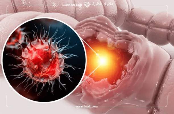علاج سرطان الأمعاء