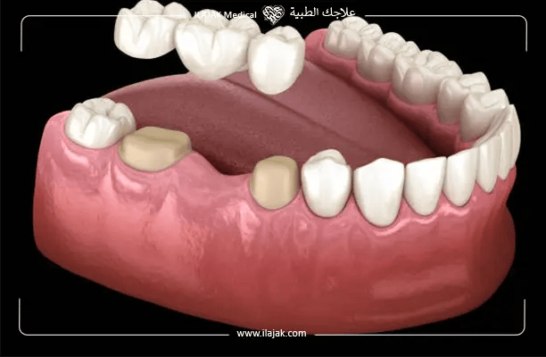 أنواع أطقم الأسنان الجزئية المتحركة