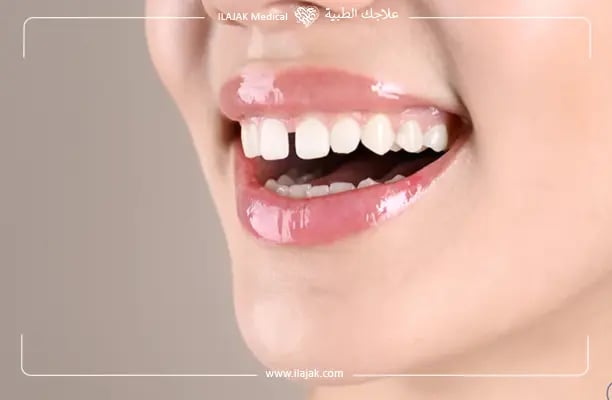 teeth Gaps