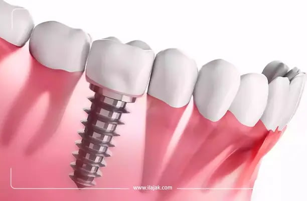  dental implants in Turkey