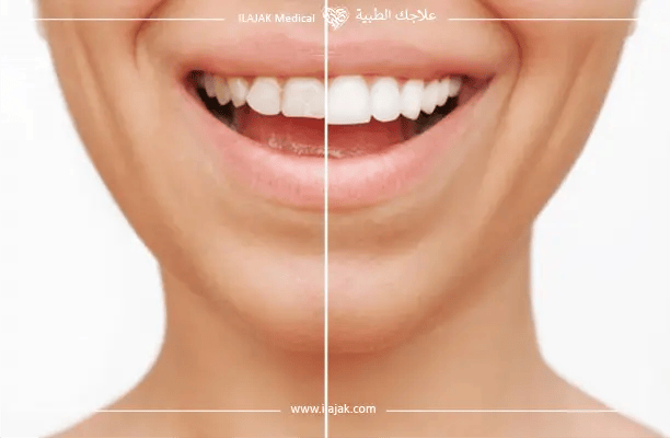 فينير الأسنان 
