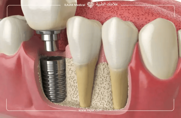 Can Dental Implants Fail Over Time