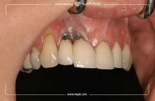 What Are the dental implant failure signs?