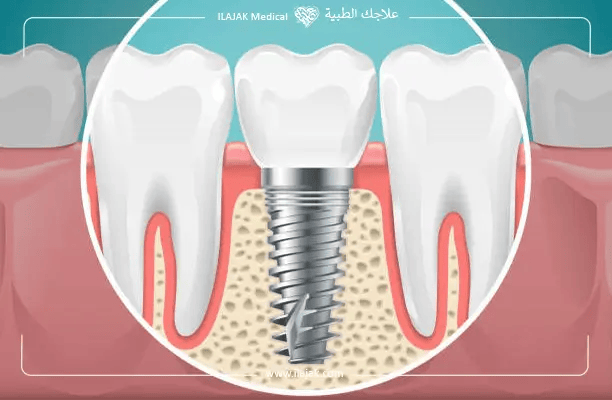 How Can Dental Implant Failure Be Avoided?