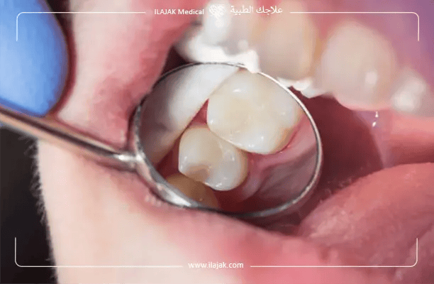 Tooth-Colored Composite Fillings