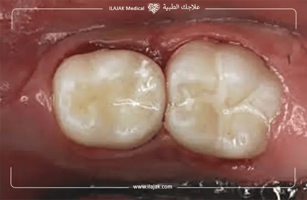 Glass-Ionomer Cement Fillings (GIC Filling)