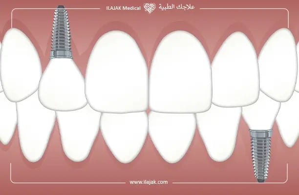 celebrity with dental implants