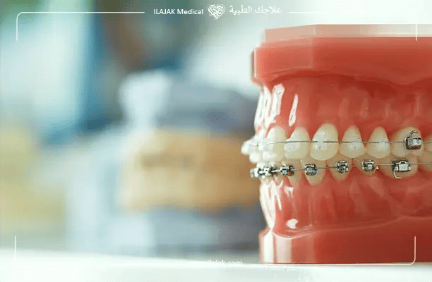 سوء اطباق الفكين