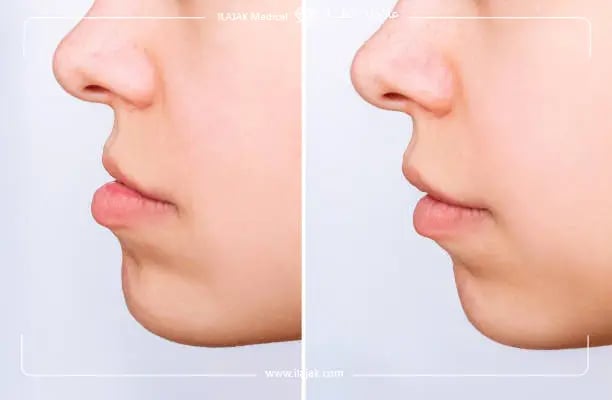 تشخيص سوء إطباق الأسنان أو سوء اطباق الفكين