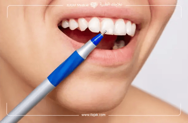 أسباب ظهور البقع البيضاء على الأسنان