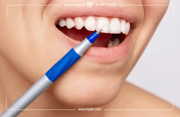 أسباب ظهور البقع البيضاء على الأسنان الأمامية